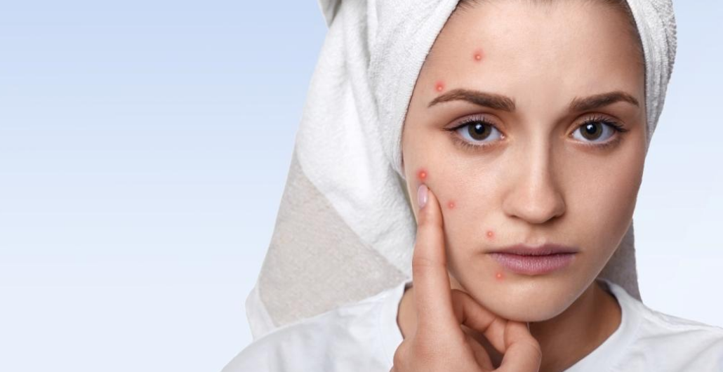 Pimples Remedies That Will Work  Wonders For Your Skin
